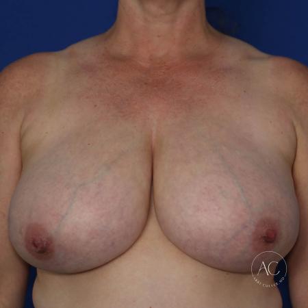 Before image 1 Case #132301 - Breast reduction