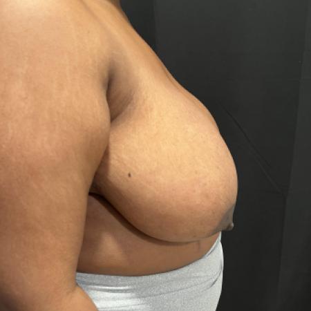 Before image 2 Case #133251 - Medial Pedicle Reduction Mammoplasty