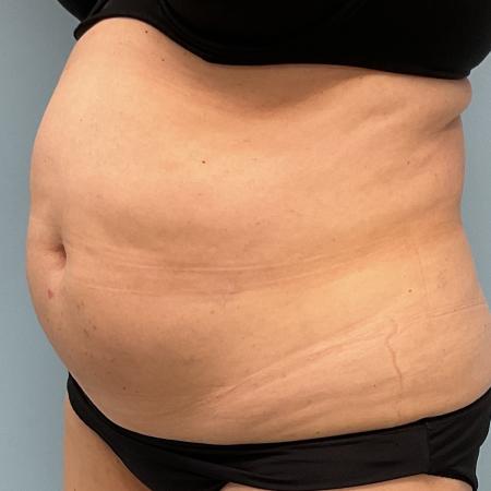 Before image 2 Case #131601 - 55 y.o. female with Lipo and Tummy Tuck
