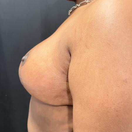After image 3 Case #133251 - Medial Pedicle Reduction Mammoplasty