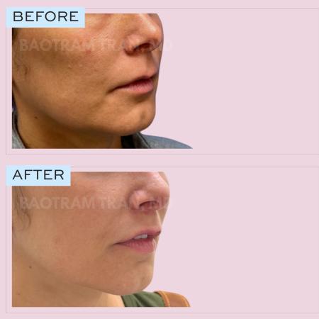 After image 1 Case #132766 - Lip lift