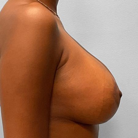 After image 3 Case #132786 - Breast Augmentation & Lift