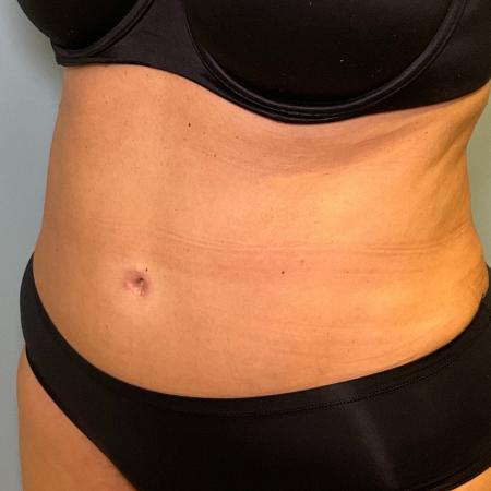 After image 2 Case #131601 - 55 y.o. female with Lipo and Tummy Tuck