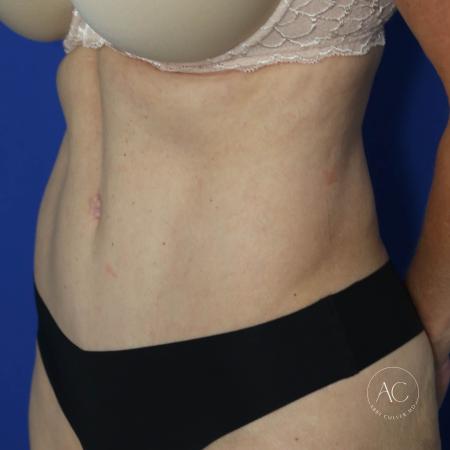 After image 2 Case #132216 - Abdominoplasty with liposuction