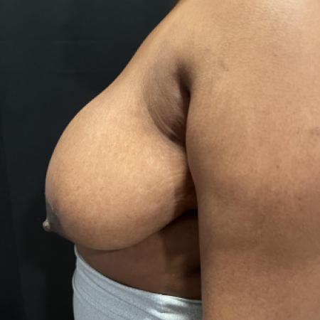 Before image 3 Case #133251 - Medial Pedicle Reduction Mammoplasty