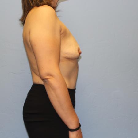 Before image 5 Case #131716 - Breast Augmentation Rao Plastic Surgery Tucson, AZ