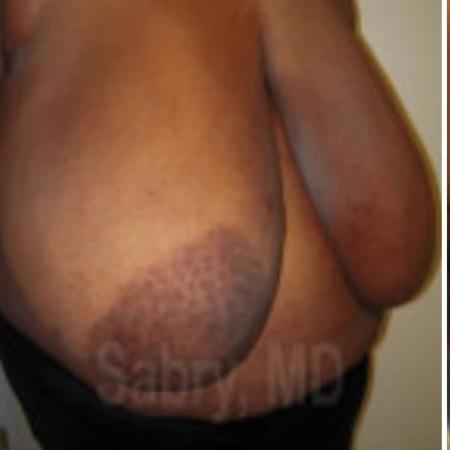 Before image 2 Case #133331 - Inferior pedicle reduction mammo with nipple graft