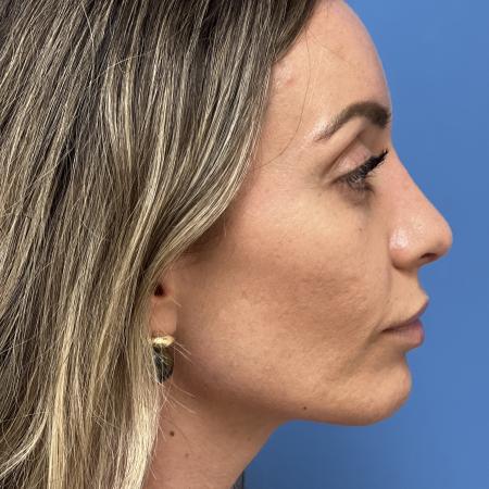 After image 3 Case #133461 - 38 year old  -  Open Rhinoplasty  -  4 months post