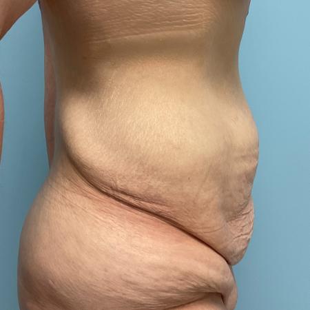 Before image 3 Case #133556 - 43 y.o. female with Tummy Tuck