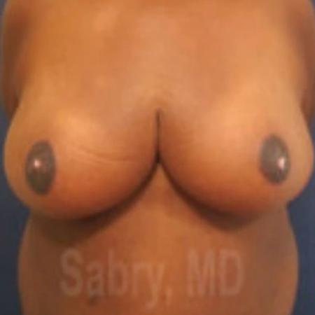 After image 1 Case #133331 - Inferior pedicle reduction mammo with nipple graft