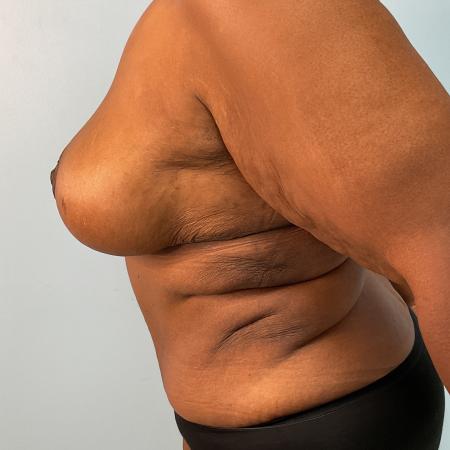 After image 3 Case #133441 - 49 y.o. female w/ Breast Reduction & Tummy Tuck