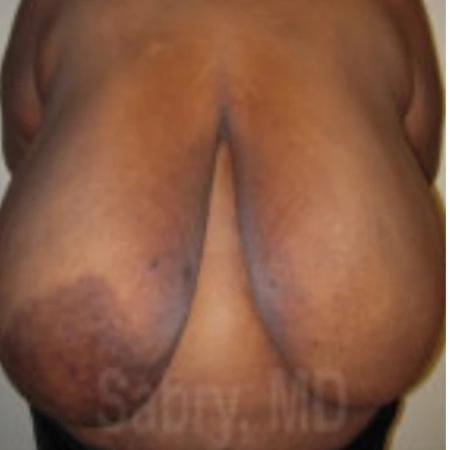 Before image 1 Case #133331 - Inferior pedicle reduction mammo with nipple graft