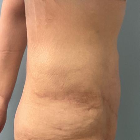 After image 3 Case #133556 - 43 y.o. female with Tummy Tuck