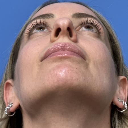 Before image 4 Case #133461 - 38 year old  -  Open Rhinoplasty  -  4 months post