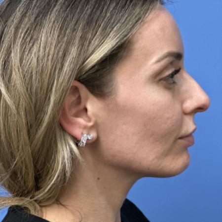 Before image 3 Case #133461 - 38 year old  -  Open Rhinoplasty  -  4 months post