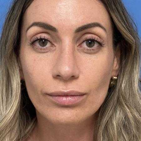 After image 1 Case #133461 - 38 year old  -  Open Rhinoplasty  -  4 months post