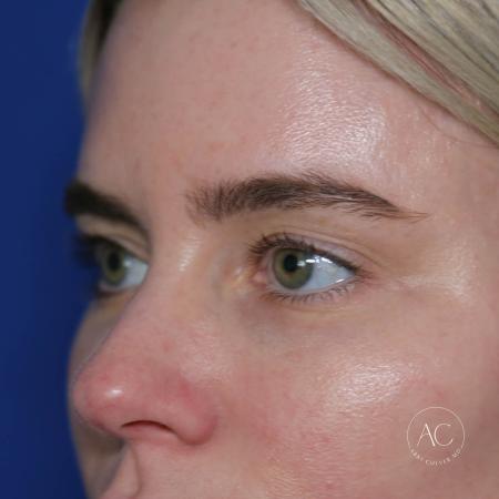 Before image 2 Case #133666 - Upper blepharoplasty