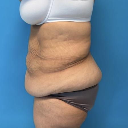 Before image 2 Case #134021 - Body Lift