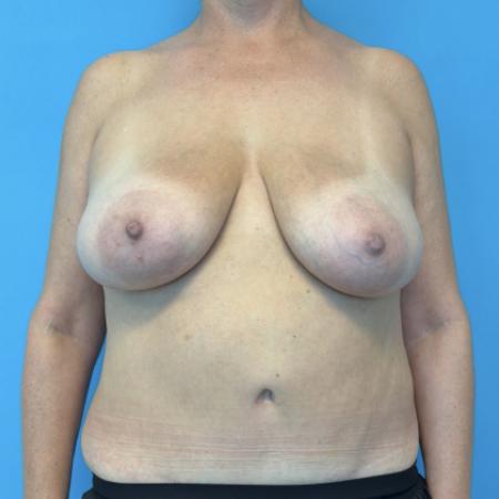 Before image 1 Case #134026 - Breast Reduction