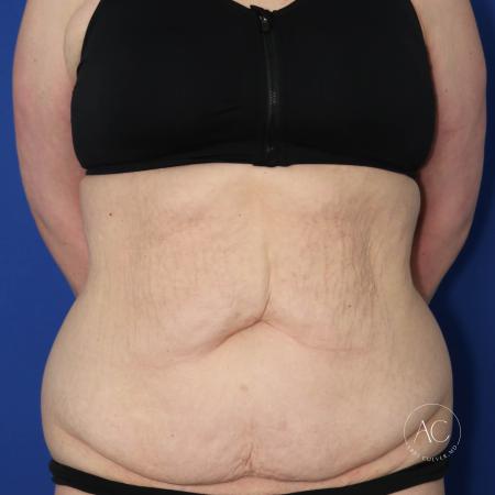 Before image 1 Case #133751 - Extended abdominoplasty with liposuction 