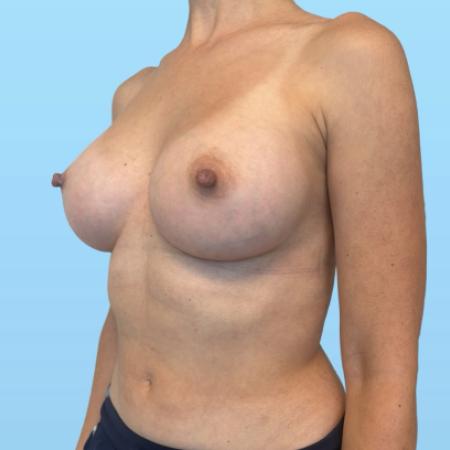 After image 2 Case #134016 - Breast Augmentation