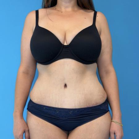 After image 1 Case #134011 - Tummy Tuck
