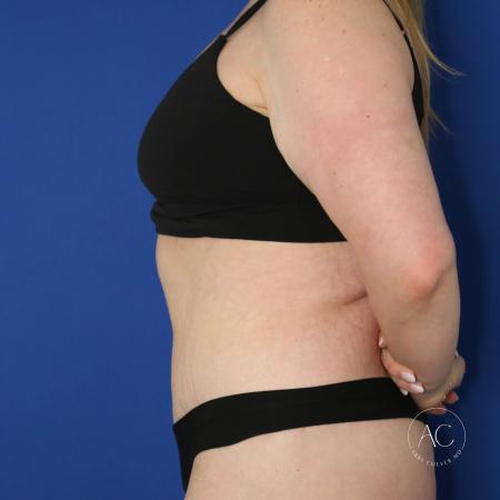 After image 3 Case #133751 - Extended abdominoplasty with liposuction 
