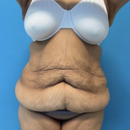 Before image 1 Case #134021 - Body Lift