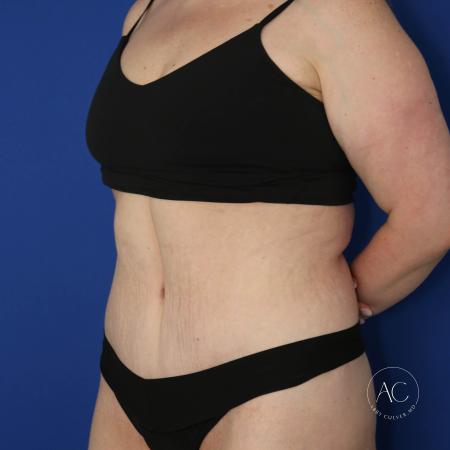 After image 2 Case #133751 - Extended abdominoplasty with liposuction 