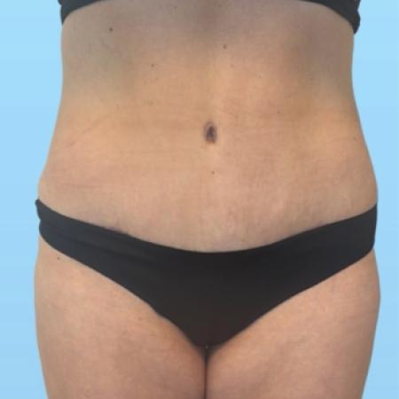 After image 1 Case #133996 - Tummy tuck