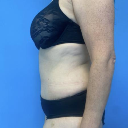 After image 3 Case #134086 - Tummy Tuck