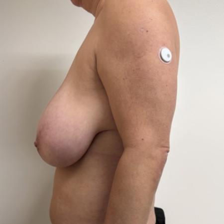 Before image 3 Case #134006 - Mommy Makeover