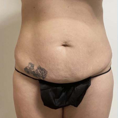 Before image 1 Case #133996 - Tummy tuck
