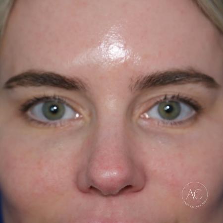 Before image 1 Case #133666 - Upper blepharoplasty