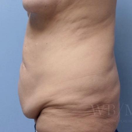 Before image 3 Case #134106 - Tummy Tuck
