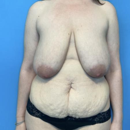 Before image 1 Case #134001 - Mommy Makeover