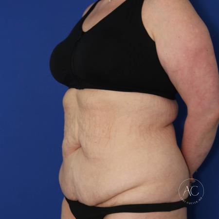 Before image 2 Case #133751 - Extended abdominoplasty with liposuction 