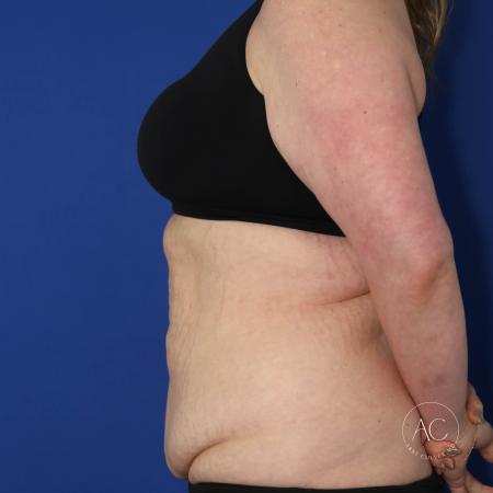 Before image 3 Case #133751 - Extended abdominoplasty with liposuction 