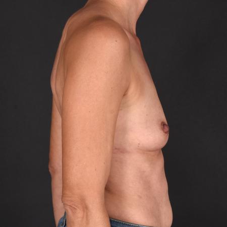Before image 3 Case #133681 - Breast Augmentation