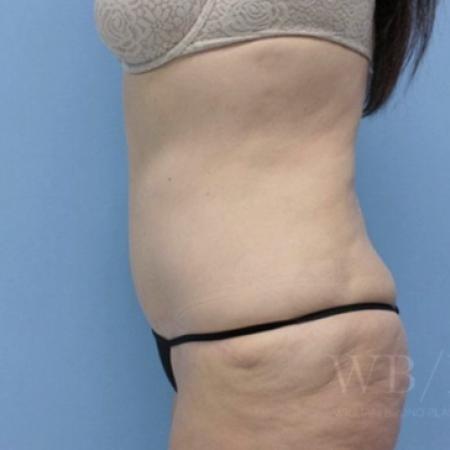 After image 3 Case #134106 - Tummy Tuck