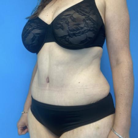 After image 2 Case #134086 - Tummy Tuck