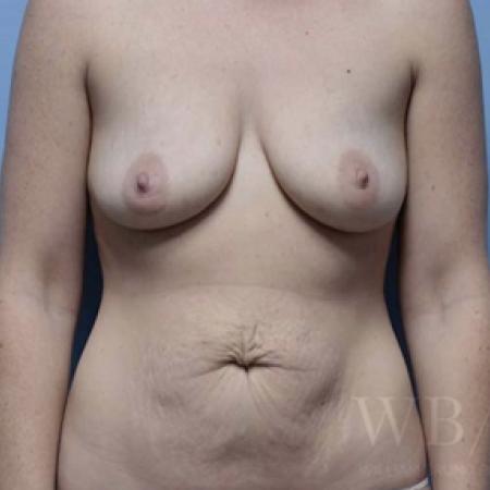 Before image 1 Case #134071 - Mommy Makeover