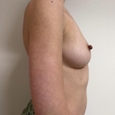 Before image 3 Case #134016 - Breast Augmentation