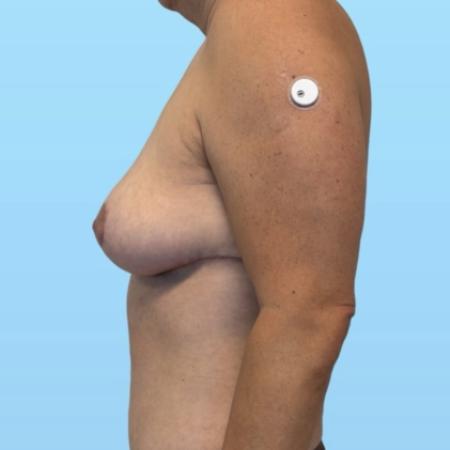 After image 3 Case #134006 - Mommy Makeover