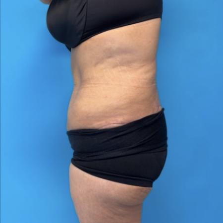 After image 2 Case #134021 - Body Lift