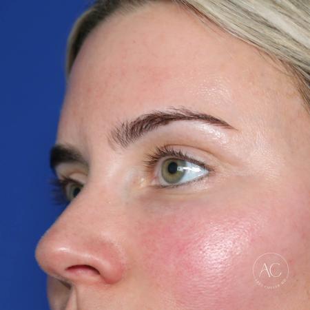 After image 2 Case #133666 - Upper blepharoplasty
