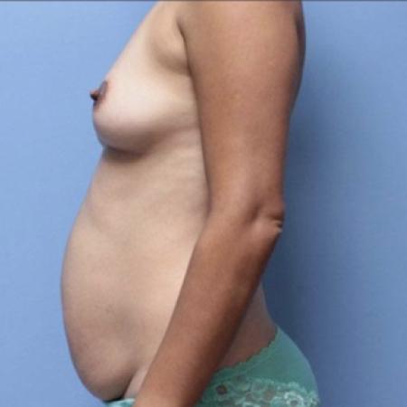 Before image 3 Case #134076 - Mommy Makeover