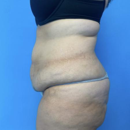 Before image 2 Case #134011 - Tummy Tuck