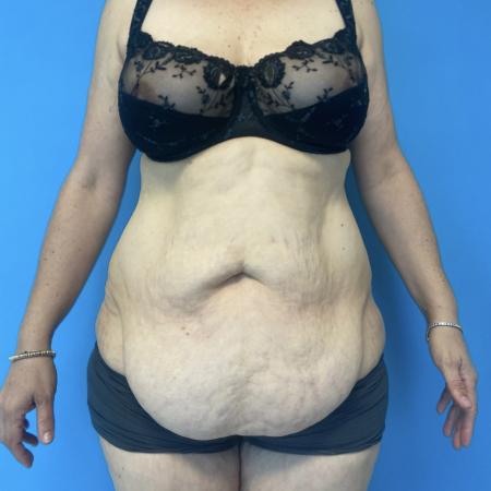 Before image 1 Case #134086 - Tummy Tuck