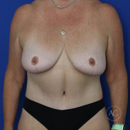 After image 1 Case #134096 - Extended abdominoplasty
